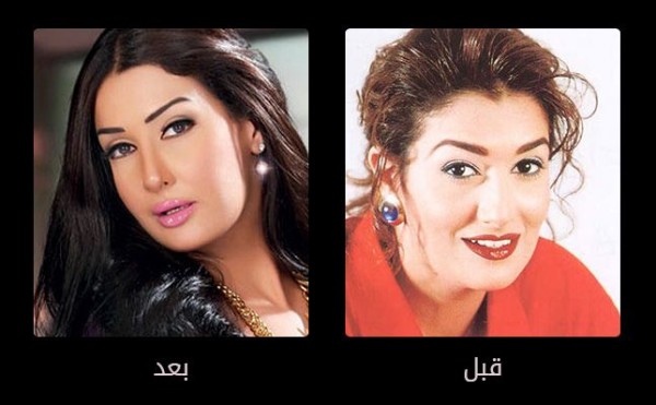 صور الفنانات قبل عمليات التجميل , اثر عمليات التجميل علي الفنانات