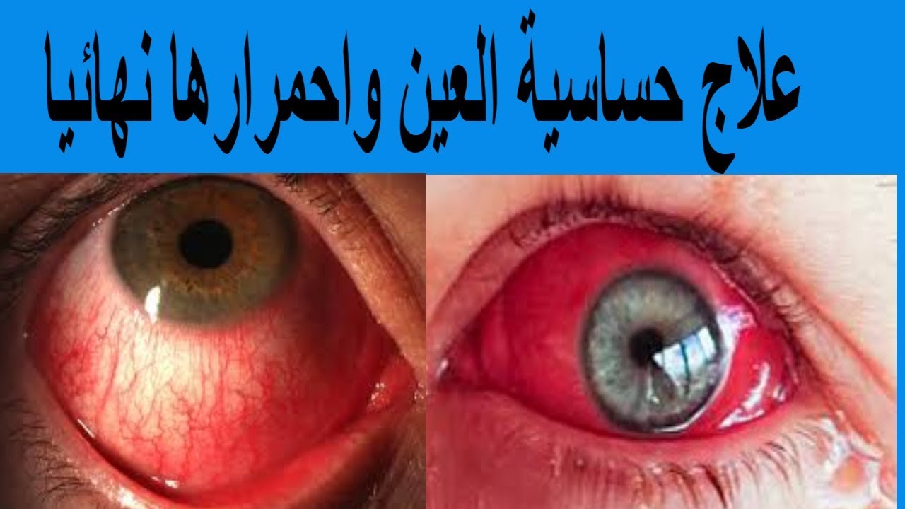 علاج حساسية العين , كيفيه التخلص من حساسيه العين - المرأة ...