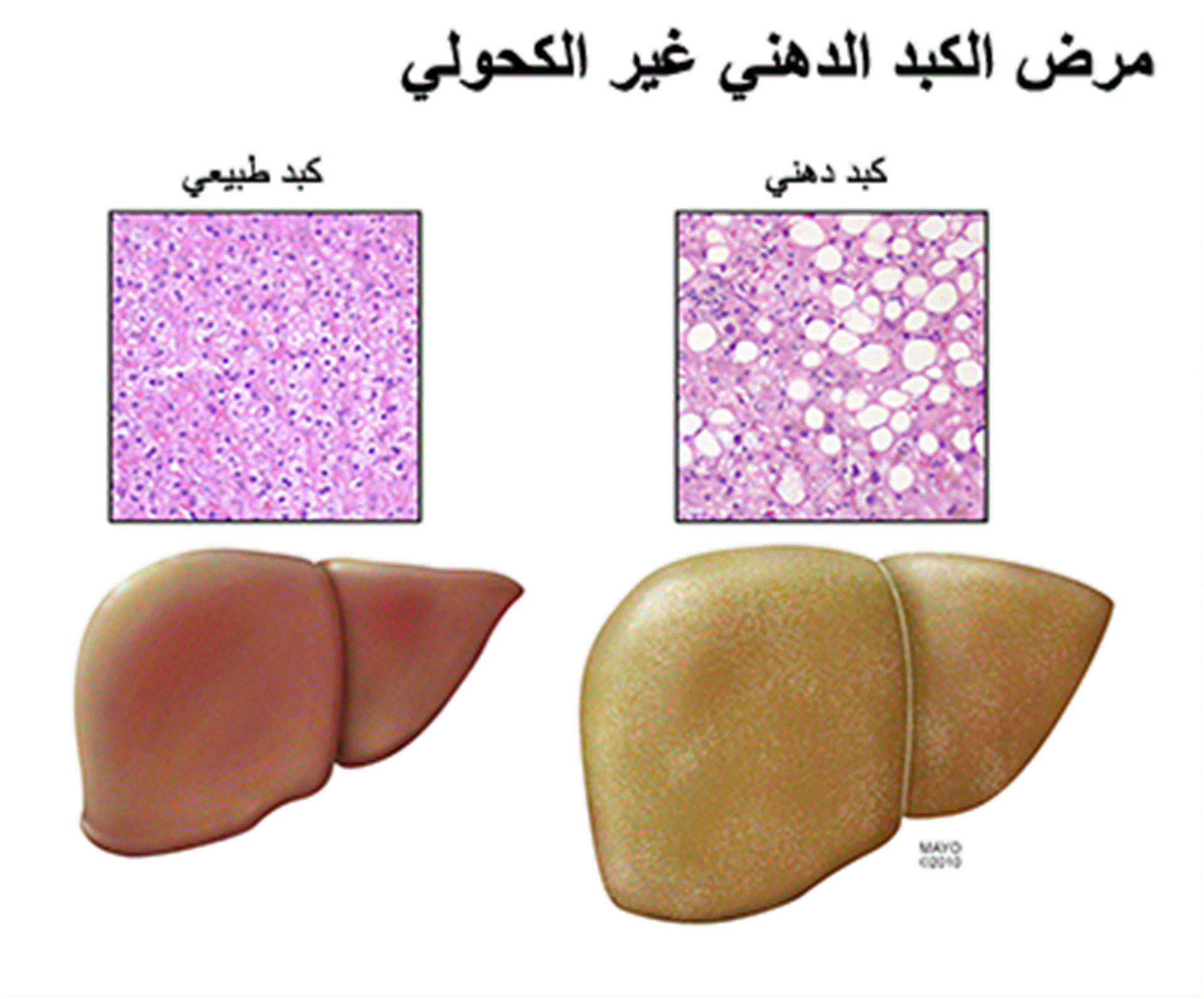 Светлый цвет печени. Ожирение печени гепатоз печени. Жировая дистрофия печени патологическая анатомия. Макропрепарат: жировая дистрофия печени (гусиная печень). Ожирение печени макропрепарат.
