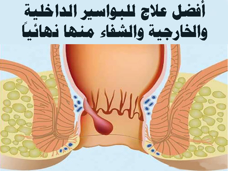 لعلاج البواسير نهائيا  , نصائح مهمة لمريض البواسير او الشرخ الشرجي