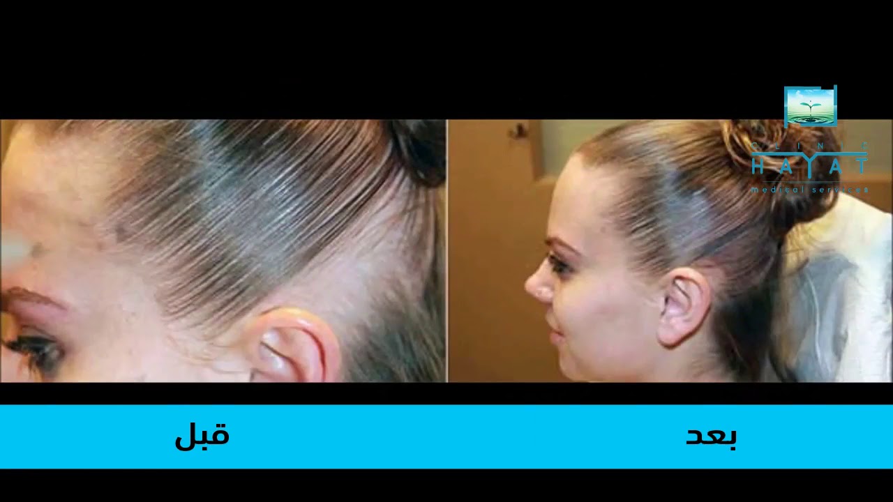 كيفية زراعة الشعر للنساء , يلا نعرف ازاى يمكن للشعر ان يزرع