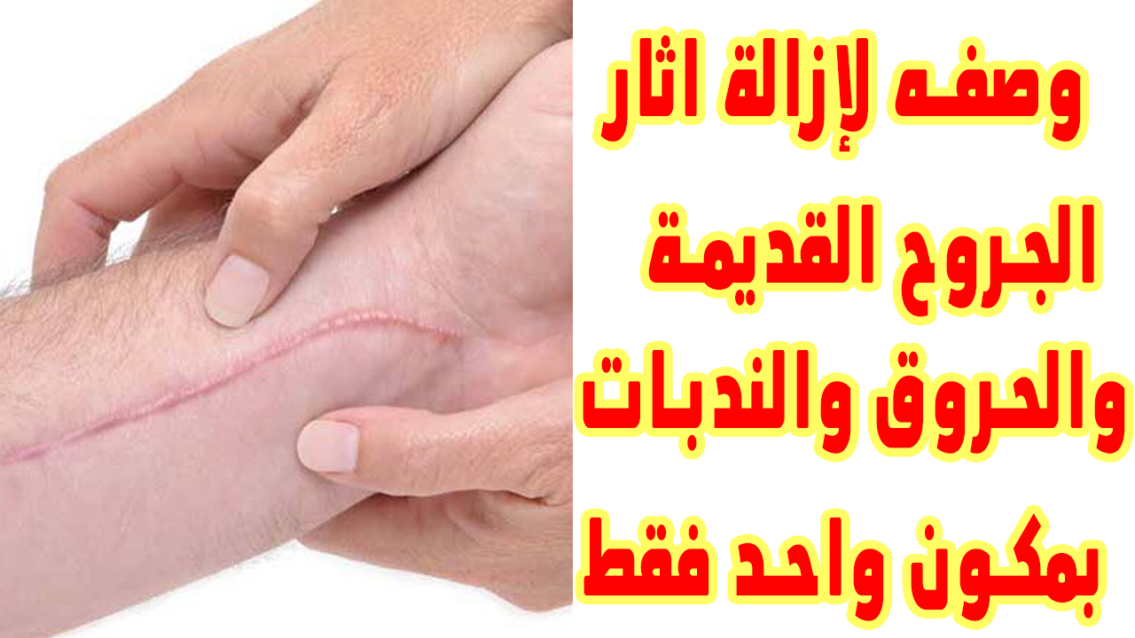 طريقة ازالة اثار الحروق-فى حاجه بسيطه ممكن تخلصك من مكان الحرق 10754 1